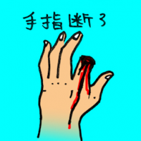 手指断了 severed finger