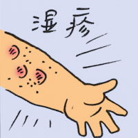 湿疹 eczema
