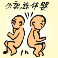 分离连体婴 separates conjoined twins