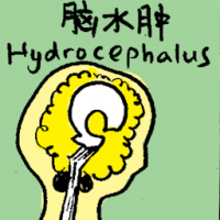 脑水肿 hydrocephalus