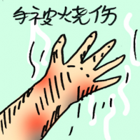 手被烧伤 burns on hand